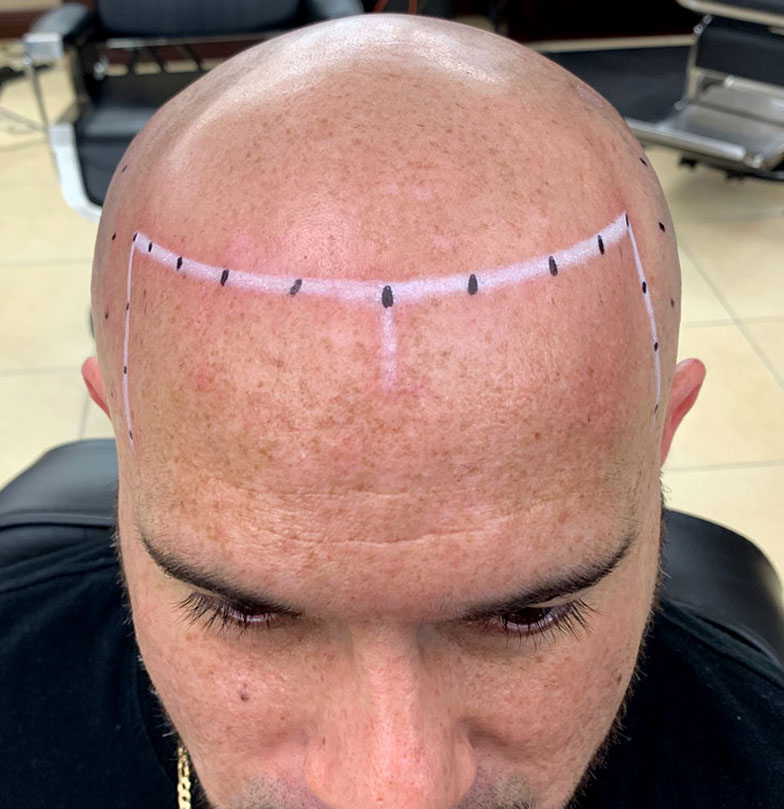 scalp micropigmentation florida