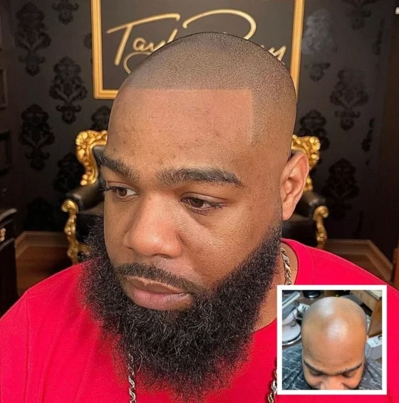 smp-results-before-and-after-hair-tattoo-taylor-perry-11
