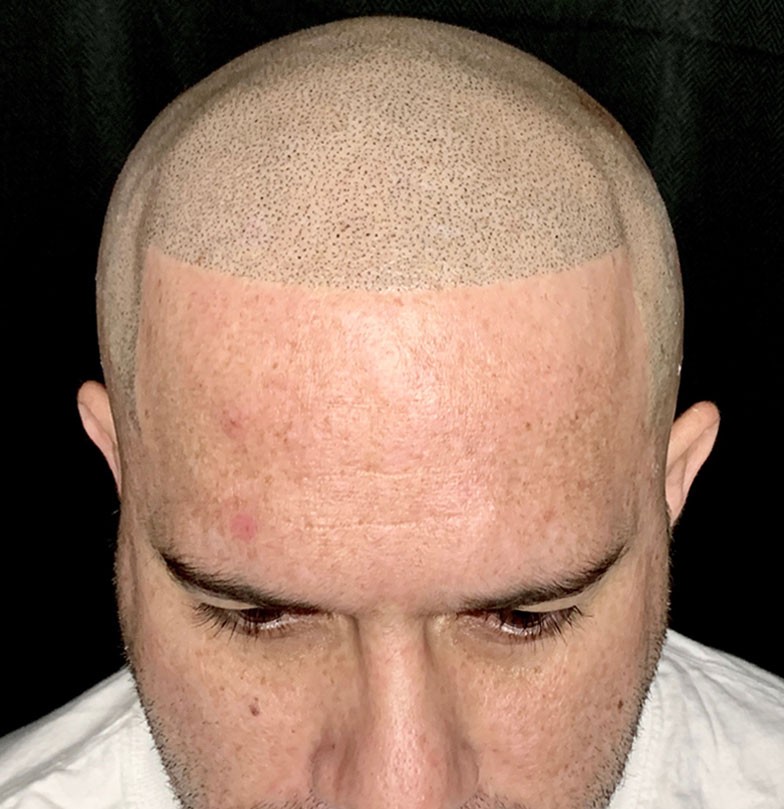 scalp micropigmentation florida